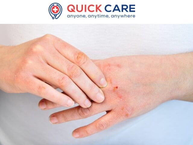 Atopic Eczema Symptoms, Diagnosis & Treatment