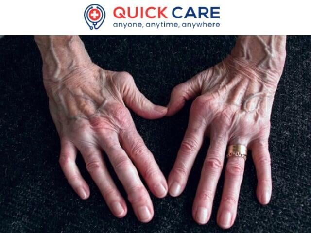 Rheumatoid arthritis - Treatment & Medications @QuickMDcare