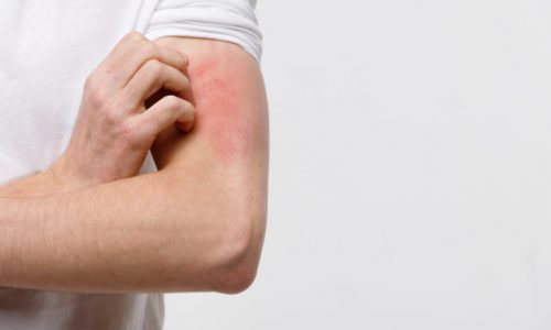 allergy