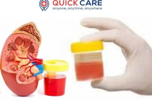 hematuria 1-img